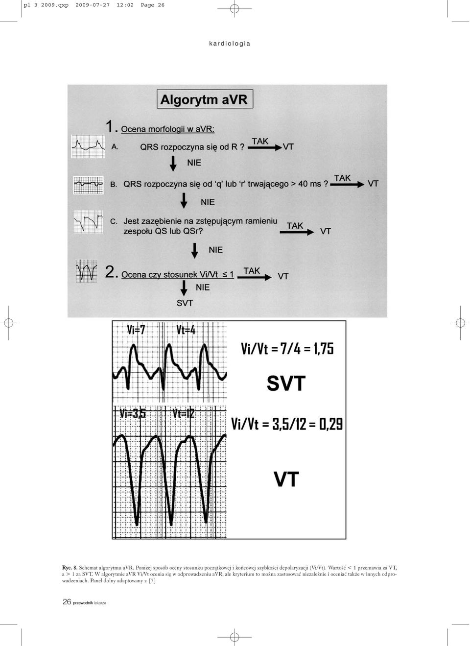 Wartoœæ < 1 przemawia za VT, a > 1 za SVT.