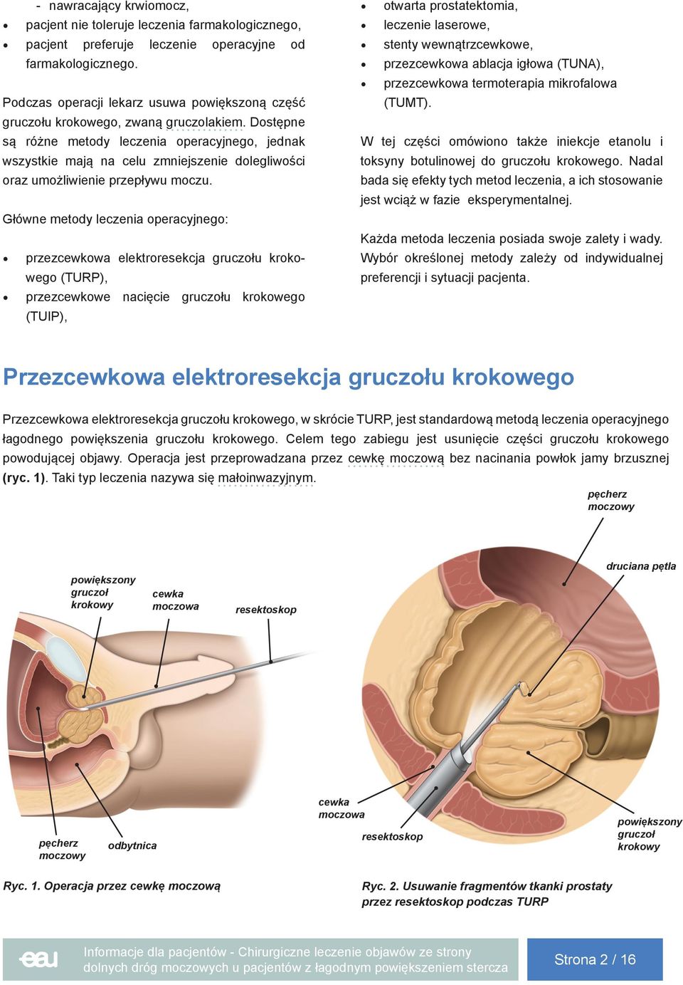 Dostępne są różne metody leczenia operacyjnego, jednak wszystkie mają na celu zmniejszenie dolegliwości oraz umożliwienie przepływu moczu.