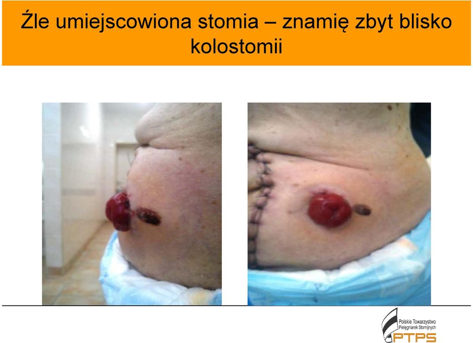 stomia znamię