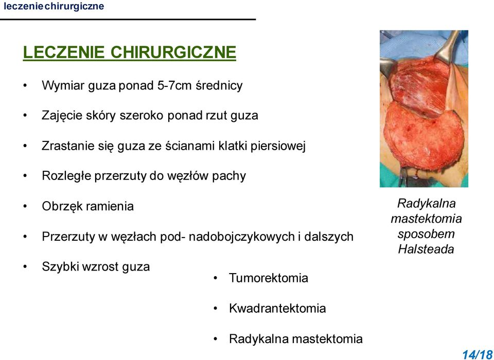 węzłów pachy Obrzęk ramienia Przerzuty w węzłach pod- nadobojczykowych i dalszych Szybki wzrost