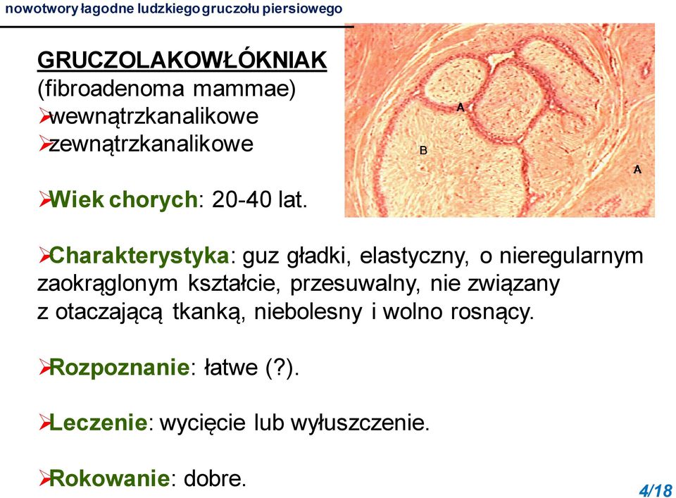 Charakterystyka: guz gładki, elastyczny, o nieregularnym zaokrąglonym kształcie, przesuwalny, nie