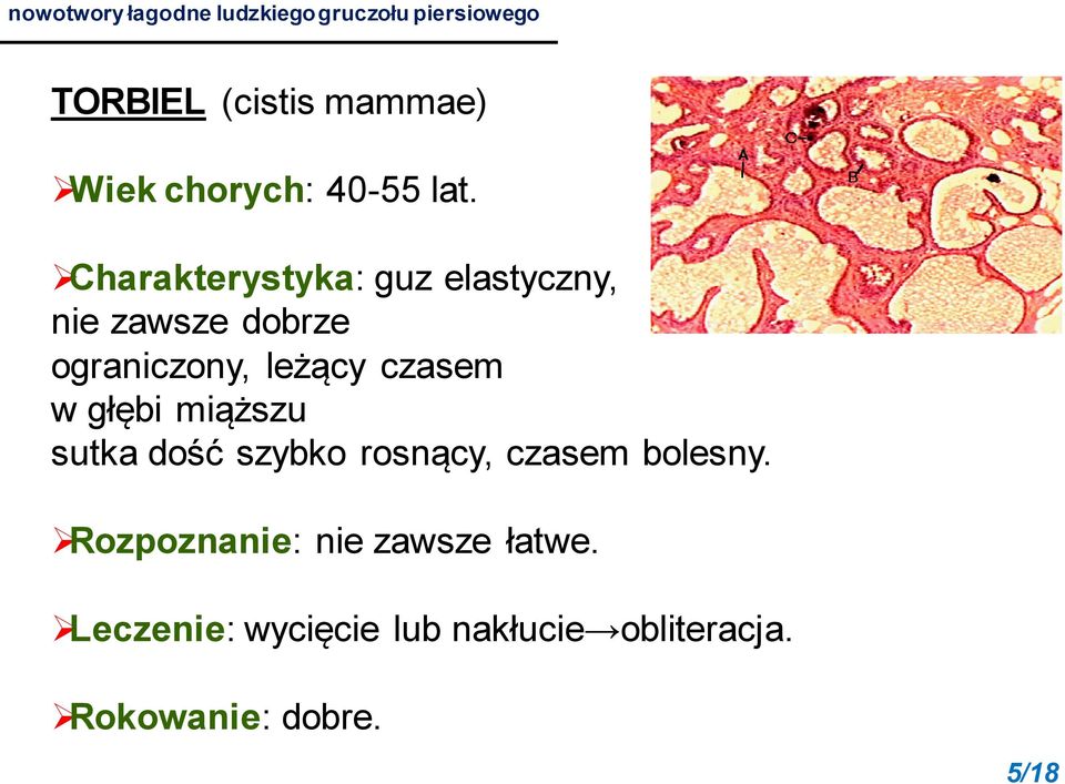 Charakterystyka: guz elastyczny, nie zawsze dobrze ograniczony, leżący czasem w