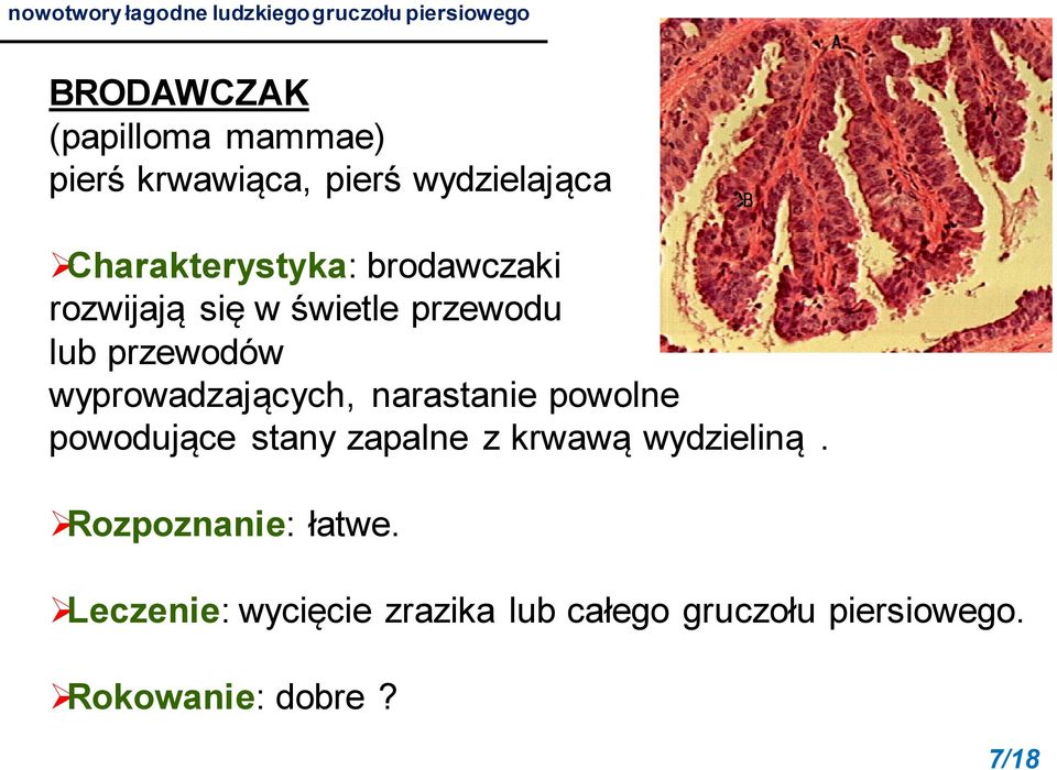 lub przewodów wyprowadzających, narastanie powolne powodujące stany zapalne z krwawą