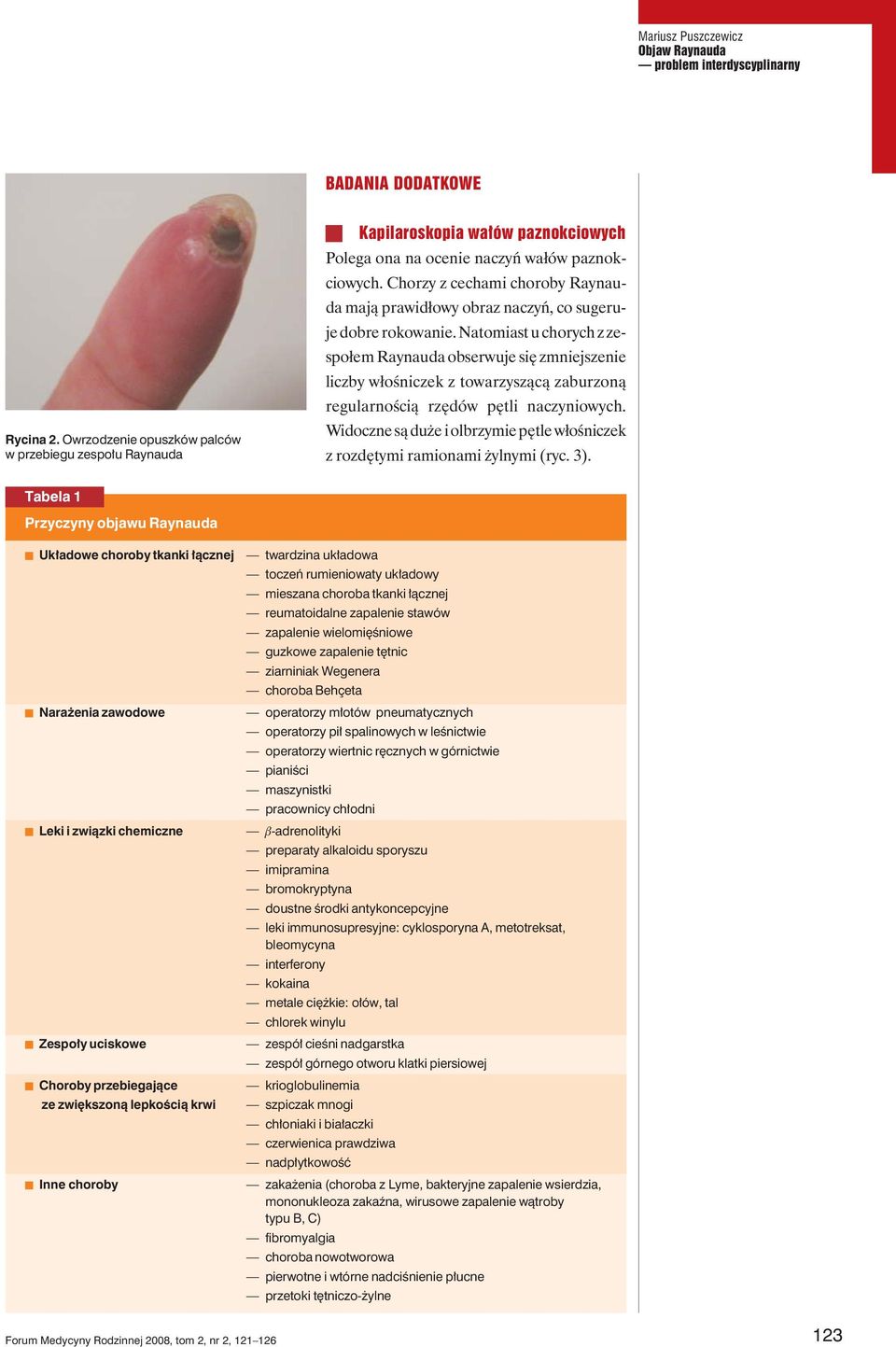 Chorzy z cechami choroby Raynauda mają prawidłowy obraz naczyń, co sugeruje dobre rokowanie.