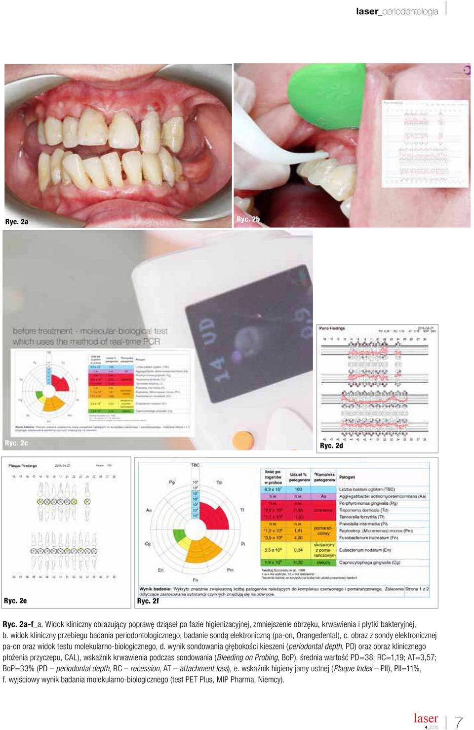 widok kliniczny przebiegu badania periodontologicznego, badanie sondą elektroniczną (pa-on, Orangedental), c. obraz z sondy elektronicznej pa-on oraz widok testu molekularno-biologicznego, d.