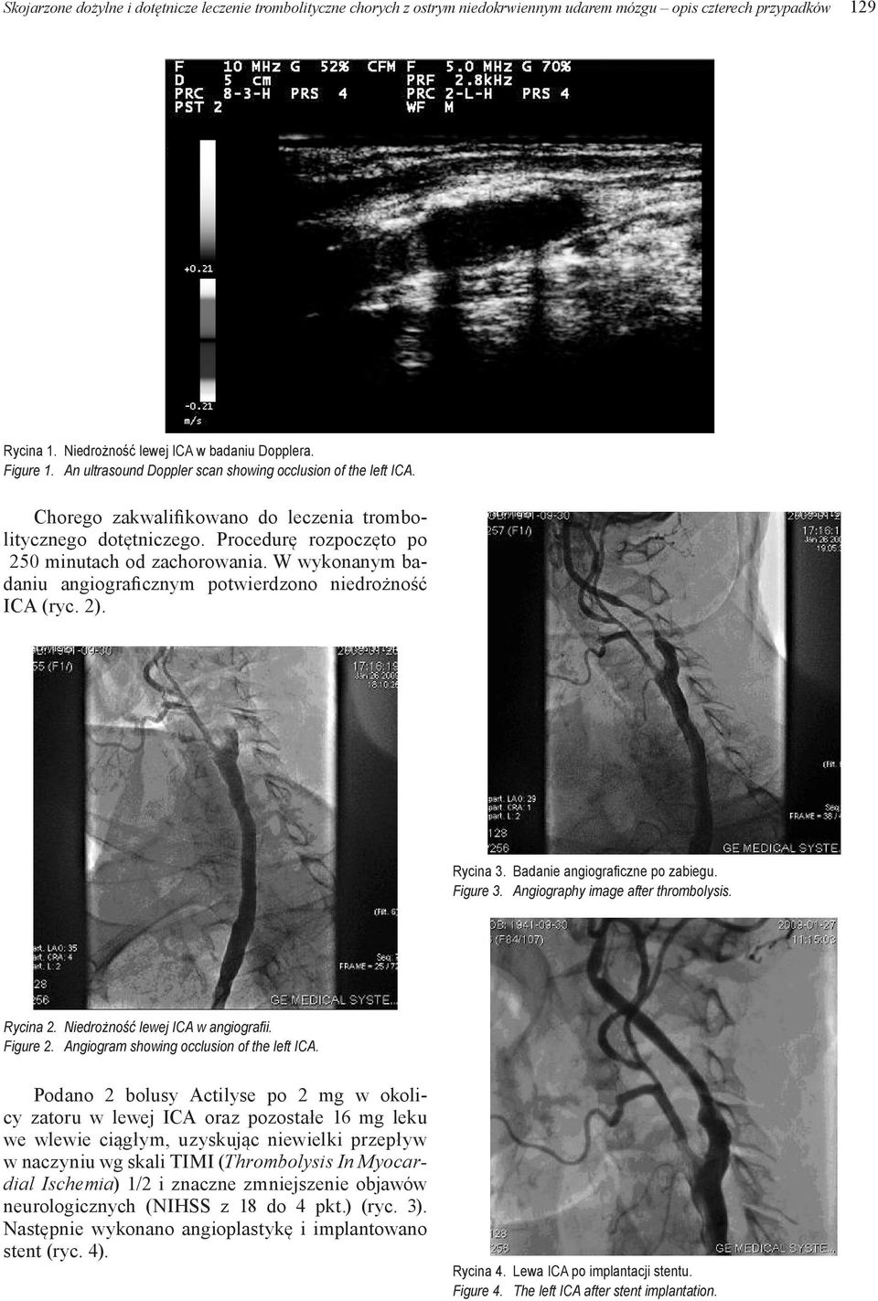 W wykonanym badaniu angiograficznym potwierdzono niedrożność ICA (ryc. 2). Rycina 3. Badanie angiograficzne po zabiegu. Figure 3. Angiography image after thrombolysis. Rycina 2.