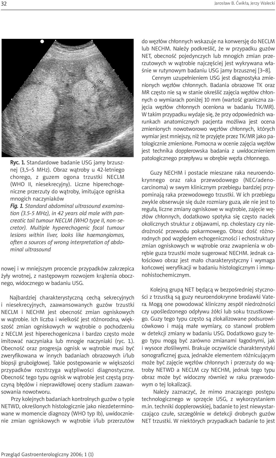 5-5 MHz), in 42 years old male with pancreatic tail tumour NECLM (WHO type II, non-secretor).