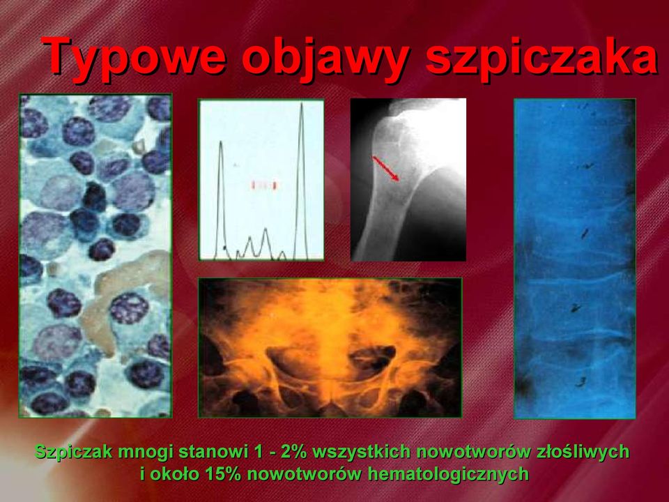 wszystkich nowotworów