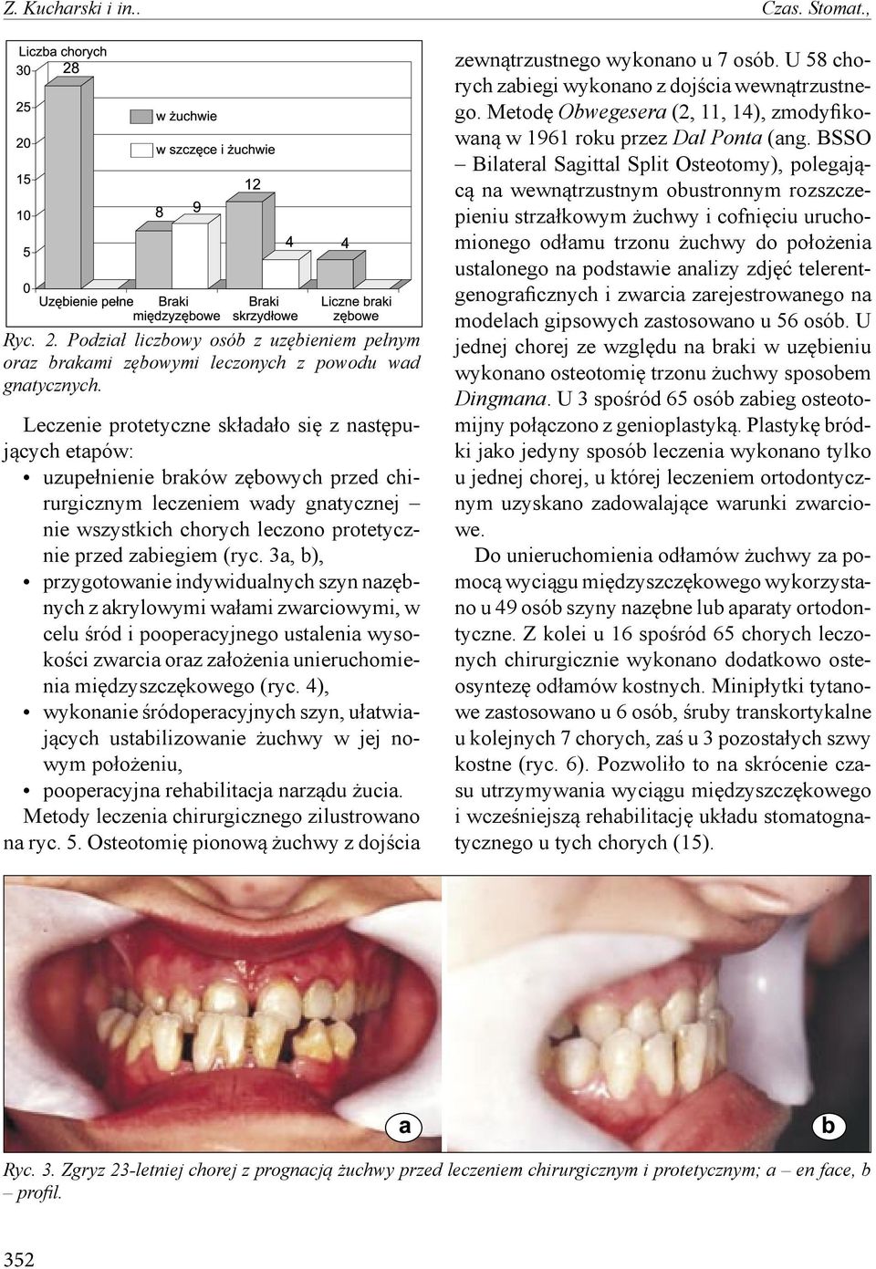 3a, b), przygotowanie indywidualnych szyn nazębnych z akrylowymi wałami zwarciowymi, w celu śród i pooperacyjnego ustalenia wysokości zwarcia oraz założenia unieruchomienia międzyszczękowego (ryc.