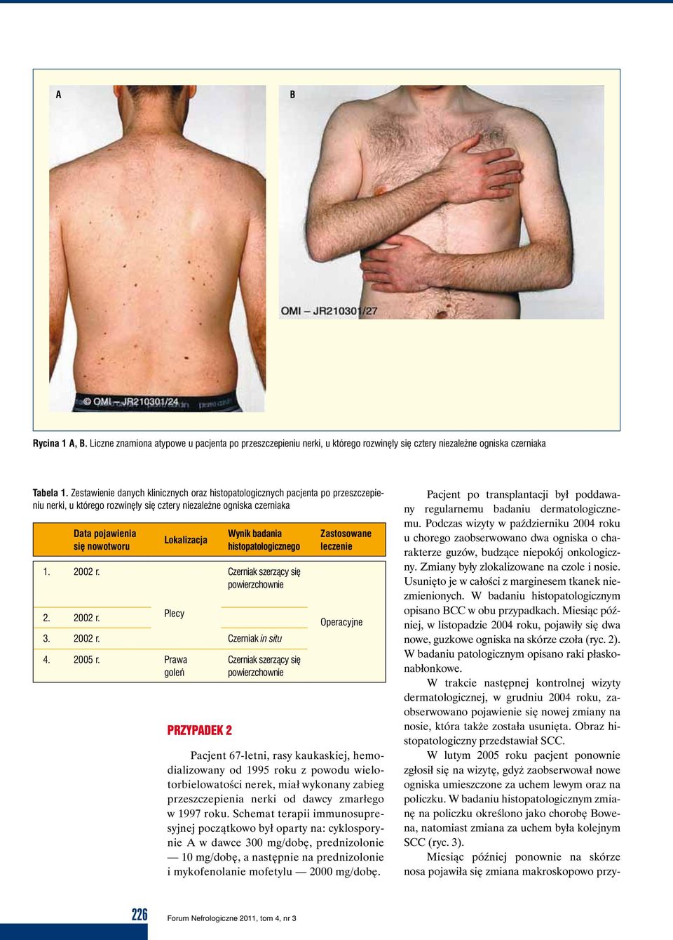 2. 2002 r. Lokalizacja Plecy PRZYPADEK 2 Wynik badania histopatologicznego Czerniak szerzący się powierzchownie 3. 2002 r. Czerniak in situ 4. 2005 r.