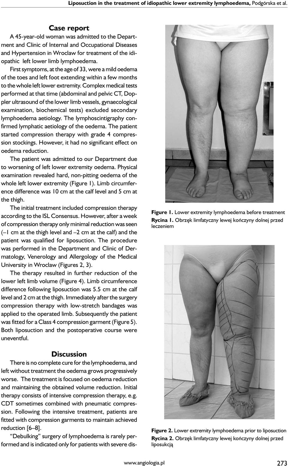 First symptoms, at the age of 33, were a mild oedema of the toes and left foot extending within a few months to the whole left lower extremity.