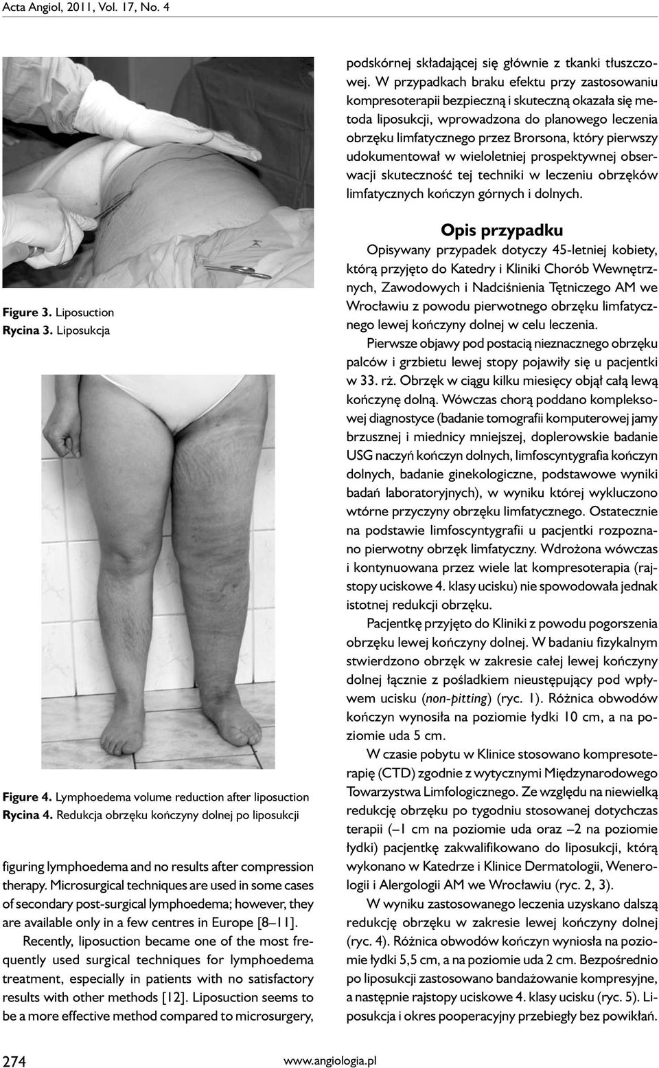pierwszy udokumentował w wieloletniej prospektywnej obserwacji skuteczność tej techniki w leczeniu obrzęków limfatycznych kończyn górnych i dolnych. Figure 3. Liposuction Rycina 3.