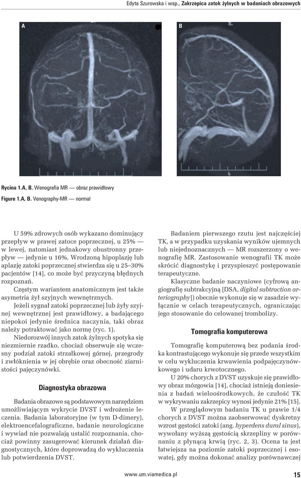 Venography-MR normal U 59% zdrowych osób wykazano dominujący przepływ w prawej zatoce poprzecznej, u 25% w lewej, natomiast jednakowy obustronny przepływ jedynie u 16%.