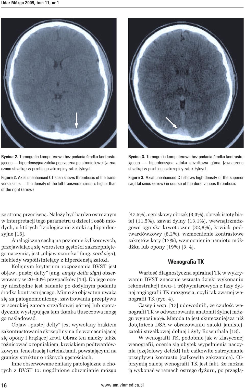 Axial unenhanced CT scan shows thrombosis of the transverse sinus the density of the left transverse sinus is higher than of the right (arrow) Rycina 3.