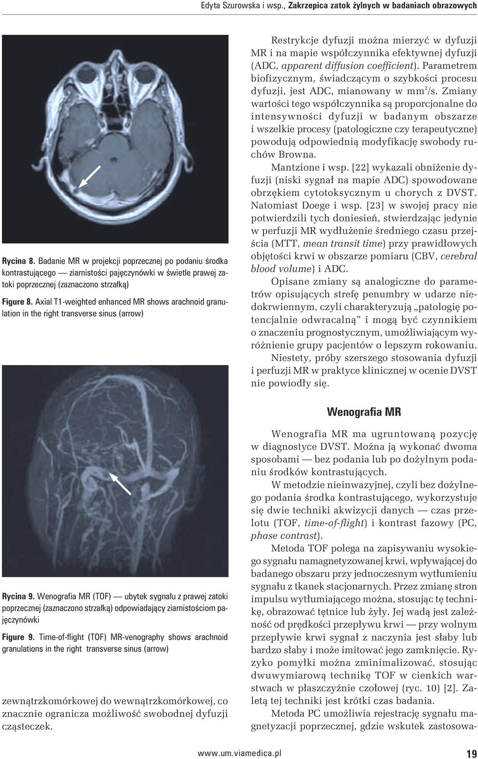 Axial T1-weighted enhanced MR shows arachnoid granulation in the right transverse sinus (arrow) Restrykcje dyfuzji można mierzyć w dyfuzji MR i na mapie współczynnika efektywnej dyfuzji (ADC,