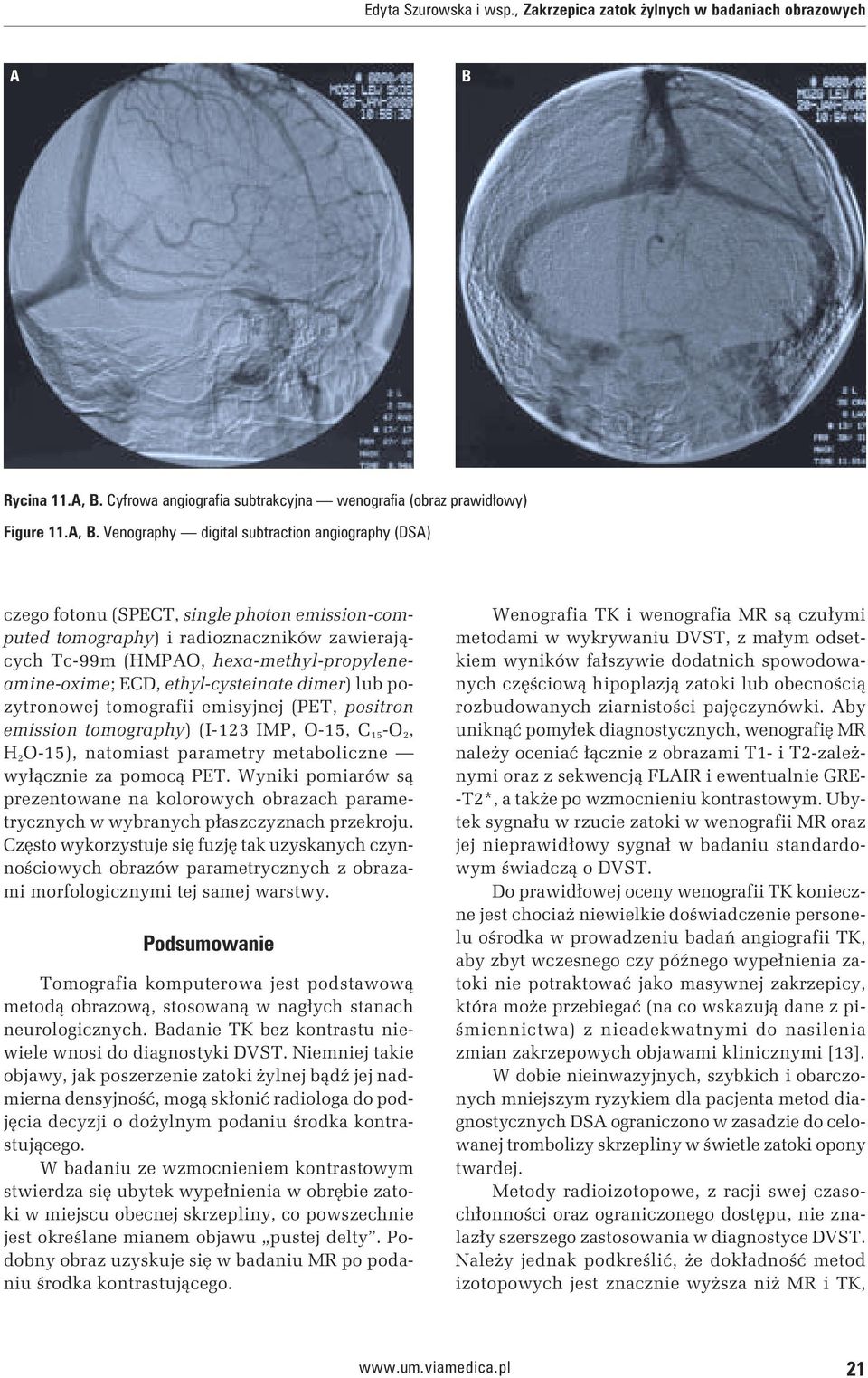 Venography digital subtraction angiography (DSA) czego fotonu (SPECT, single photon emission-computed tomography) i radioznaczników zawierających Tc-99m (HMPAO, hexa-methyl-propyleneamine-oxime; ECD,
