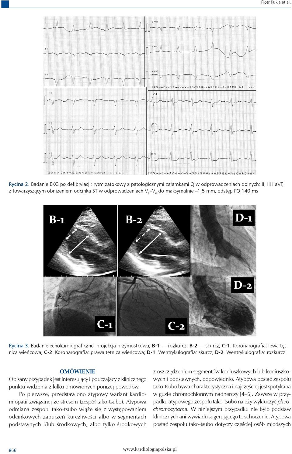 odstęp PQ 140 ms Rycina 3. Badanie echokardiograficzne, projekcja przymostkowa; B-1 rozkurcz; B-2 skurcz; C-1. Koronarografia: lewa tętnica wieńcowa; C-2. Koronarografia: prawa tętnica wieńcowa; D-1.