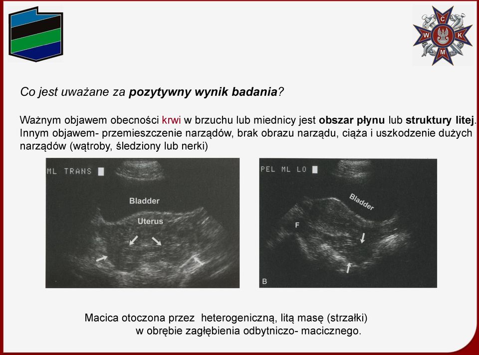 Innym objawem- przemieszczenie narządów, brak obrazu narządu, ciąża i uszkodzenie dużych