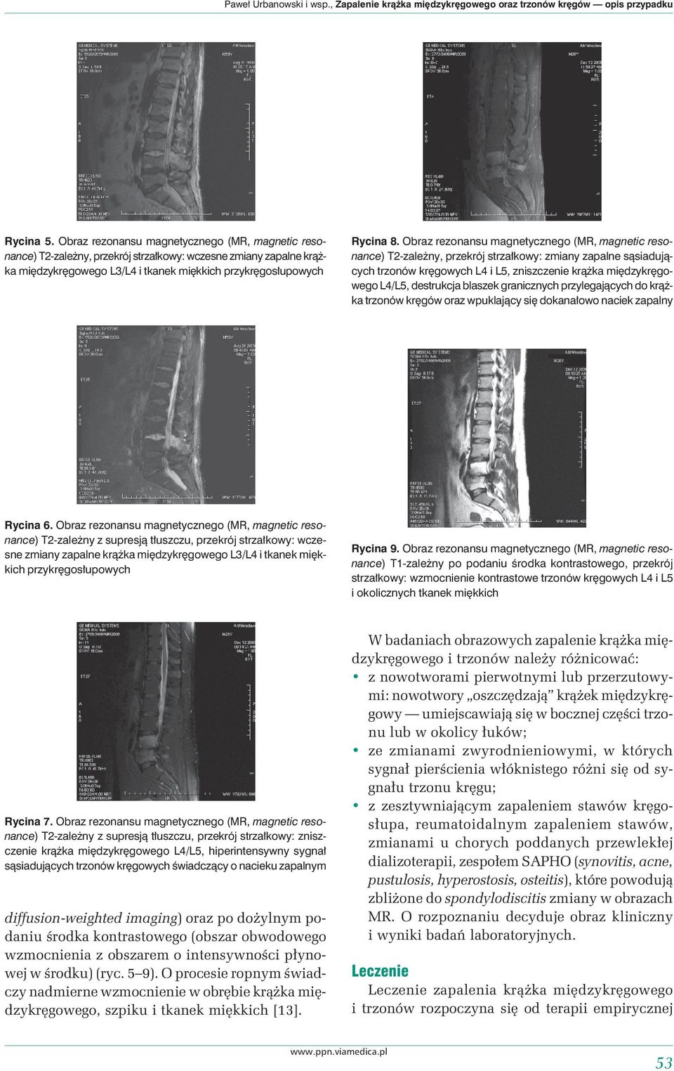 Obraz rezonansu magnetycznego (MR, magnetic resonance) T2-zależny, przekrój strzałkowy: zmiany zapalne sąsiadujących trzonów kręgowych L4 i L5, zniszczenie krążka międzykręgowego L4/L5, destrukcja