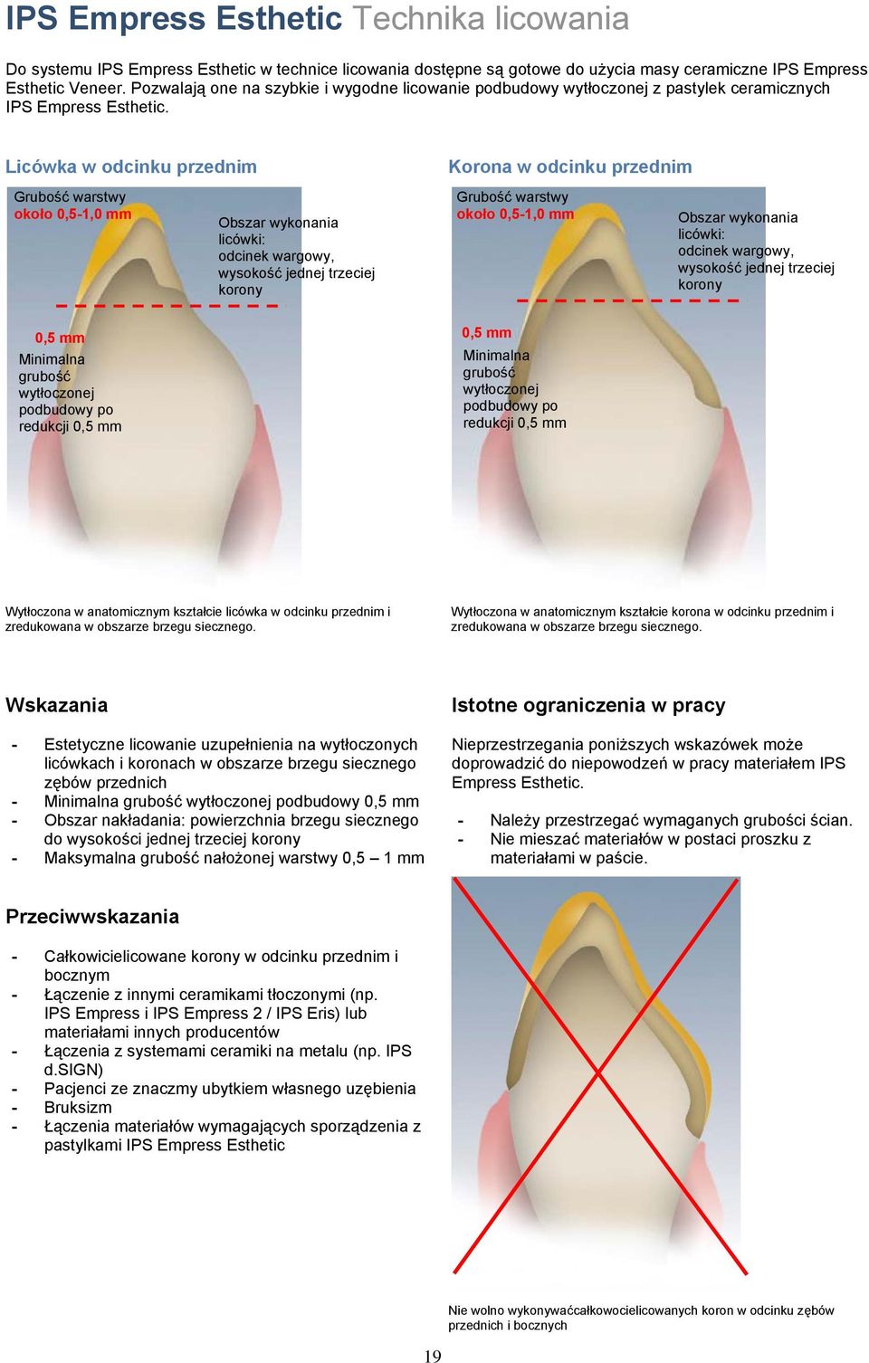Licówka w odcinku przednim Korona w odcinku przednim Grubość warstwy około 0,5-1,0 mm Obszar wykonania licówki: odcinek wargowy, wysokość jednej trzeciej korony Grubość warstwy około 0,5-1,0 mm