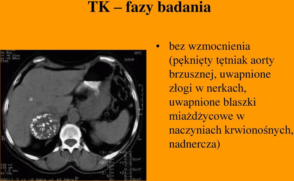 uwapnione złogi w nerkach, uwapnione