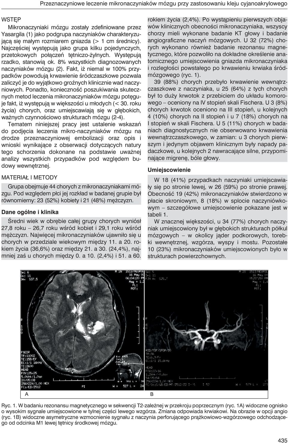 8% wszystkich diagnozowanych naczyniaków mózgu (2). Fakt, iż niemal w 100% przypadków powodują krwawienie śródczaszkowe pozwala zaliczyć je do wyjątkowo groźnych klinicznie wad naczyniowych.