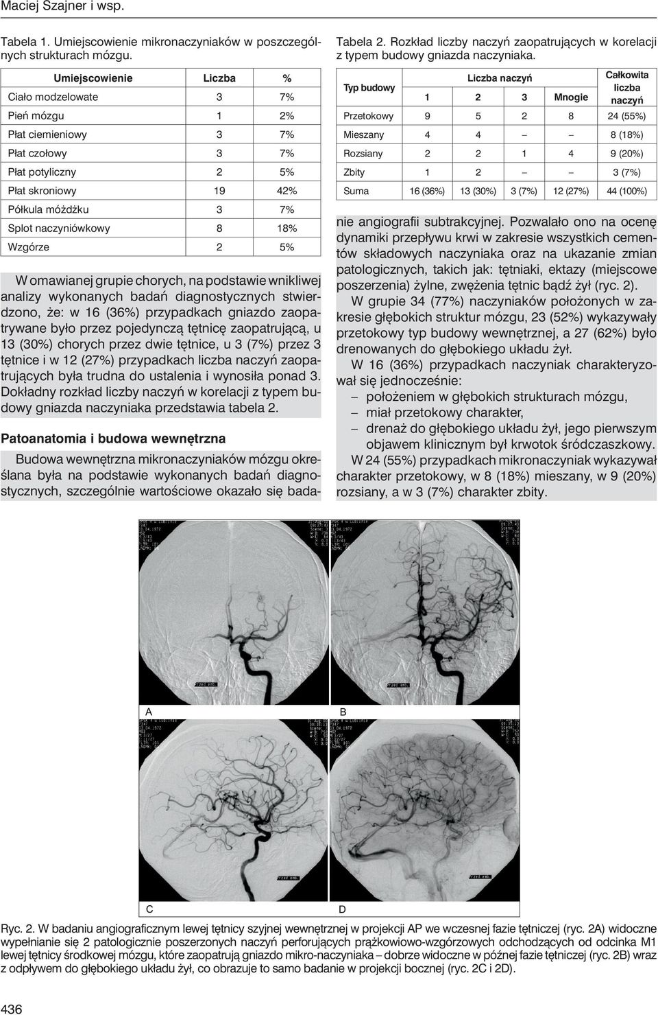 Wzgórze 2 5% W omawianej grupie chorych, na podstawie wnikliwej analizy wykonanych badań diagnostycznych stwierdzono, że: w 16 (36%) przypadkach gniazdo zaopatrywane było przez pojedynczą tętnicę
