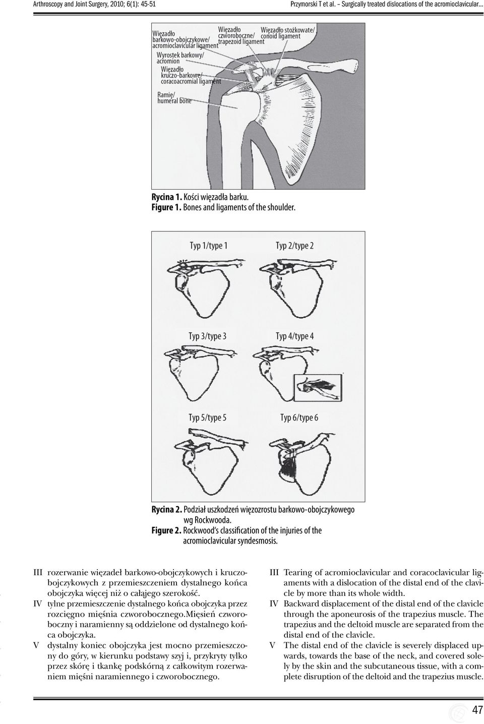 Rockwood s classification of the injuries of the acromioclavicular syndesmosis.