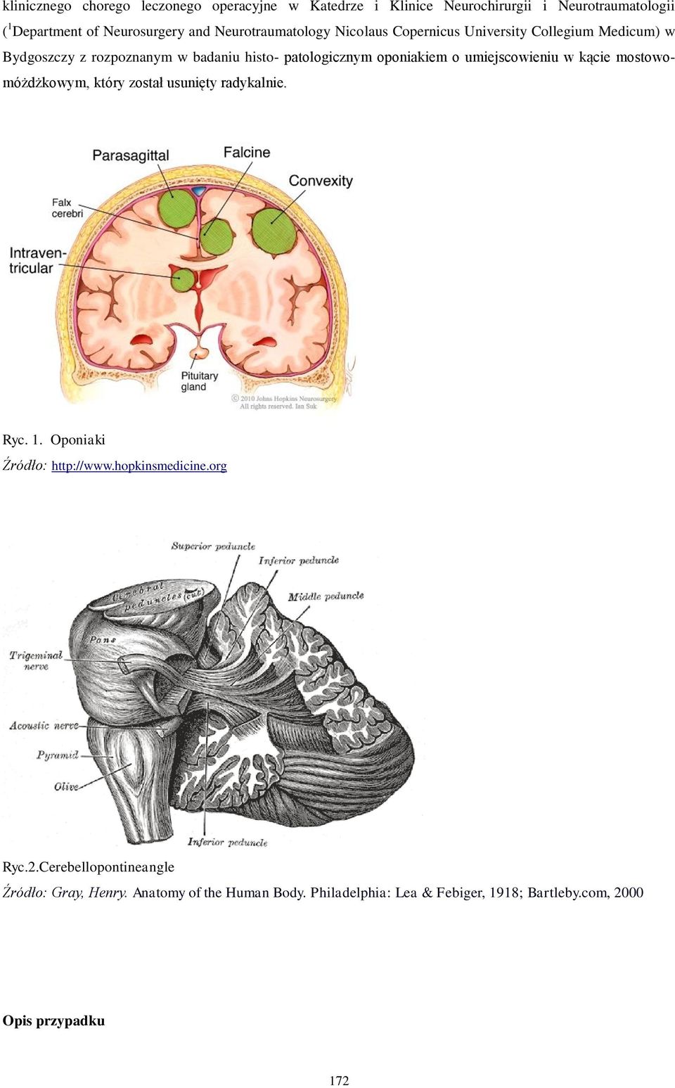 o umiejscowieniu w kącie mostowomóżdżkowym, który został usunięty radykalnie. Ryc. 1. Oponiaki Źródło: http://www.hopkinsmedicine.org Ryc.