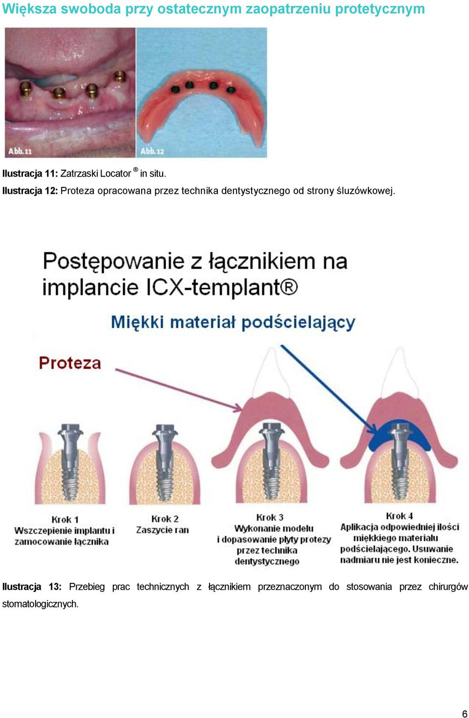 Ilustracja 12: Proteza opracowana przez technika dentystycznego od strony