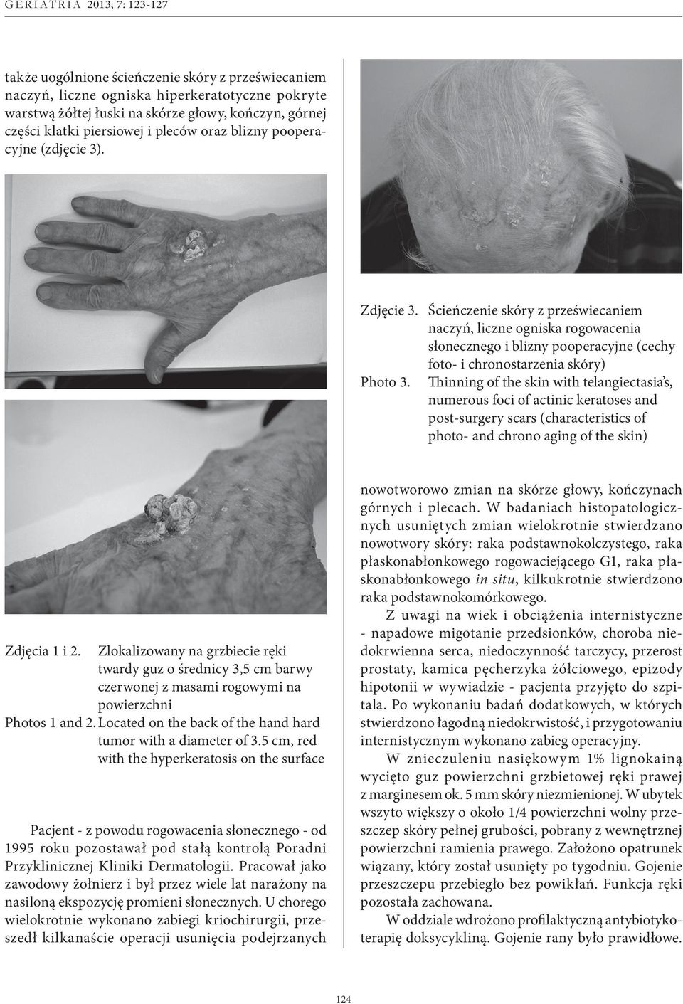 Thinning of the skin with telangiectasia s, numerous foci of actinic keratoses and post-surgery scars (characteristics of photo- and chrono aging of the skin) Zdjęcia 1 i 2.