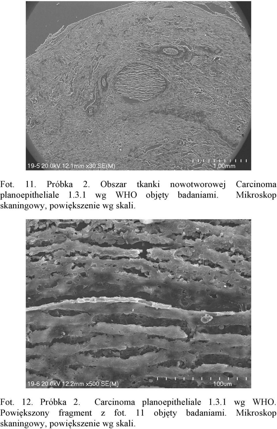 Carcinoma Mikroskop Fot. 12. Próbka 2. Carcinoma planoepitheliale 1.3.