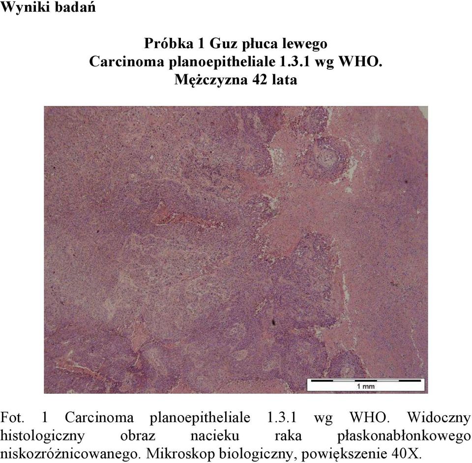1 Carcinoma planoepitheliale 1.3.1 wg WHO.