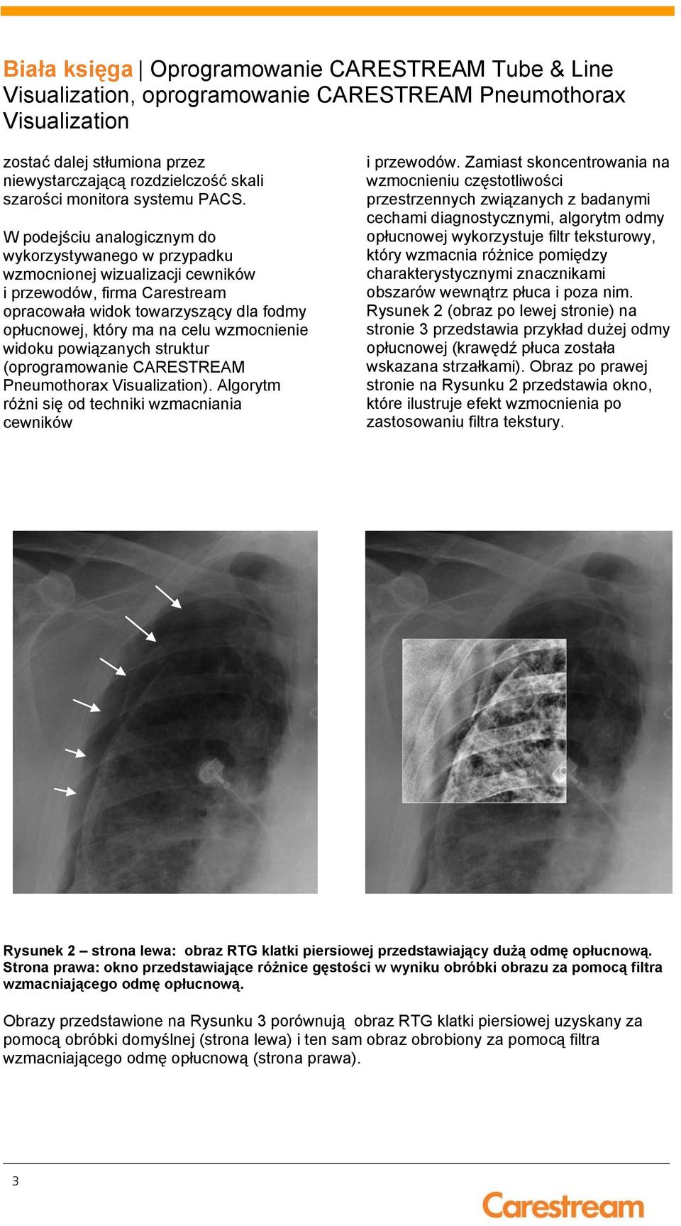 wzmocnienie widoku powiązanych struktur (oprogramowanie CARESTREAM Pneumothorax ). Algorytm różni się od techniki wzmacniania cewników i przewodów.