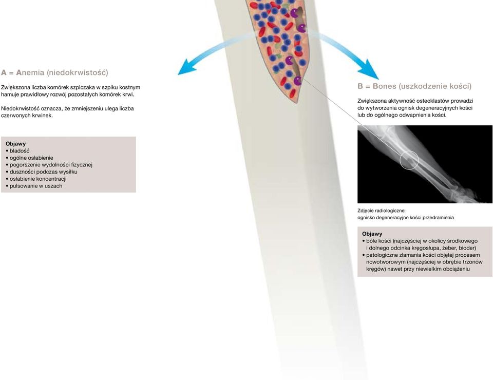 B = Bones (uszkodzenie kości) Zwiększona aktywność osteoklastów prowadzi do wytworzenia ognisk degeneracyjnych kości lub do ogólnego odwapnienia kości.