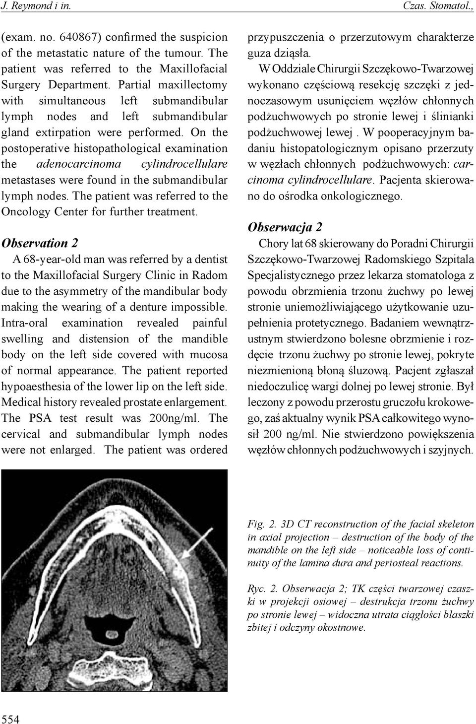 On the postoperative histopathological examination the adenocarcinoma cylindrocellulare metastases were found in the submandibular lymph nodes.