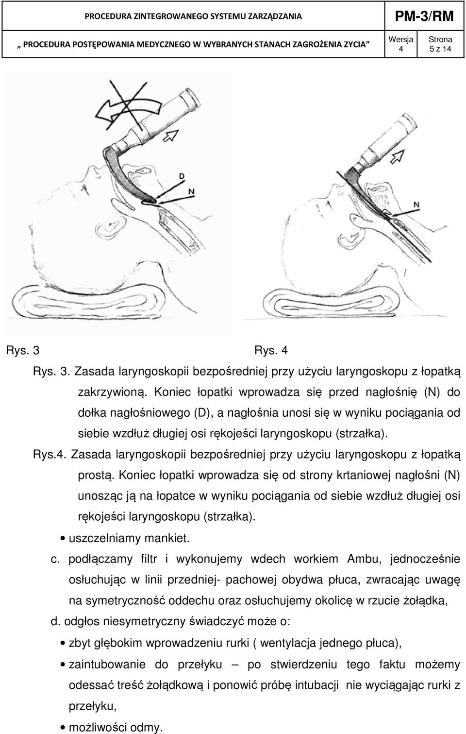 . Zasada laryngoskopii bezpośredniej przy użyciu laryngoskopu z łopatką prostą.