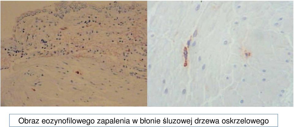 zapalenia w