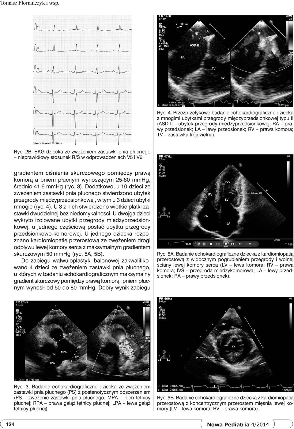 RV prawa komora; TV zastawka trójdzielna). Ryc. 2B. EKG dziecka ze zwężeniem zastawki pnia płucnego nieprawidłowy stosunek R/S w odprowadzeniach V5 i V6.