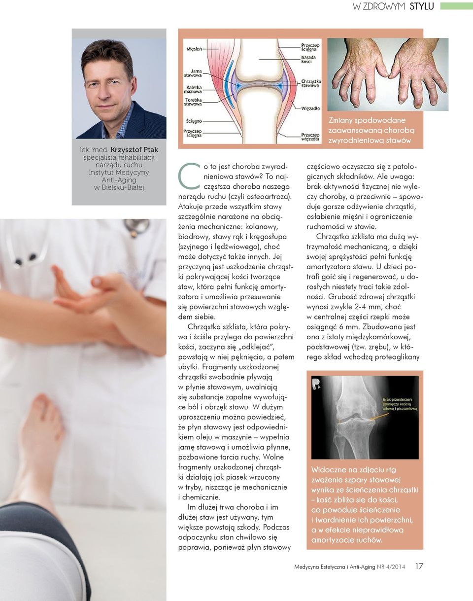 To najczęstsza choroba naszego narządu ruchu (czyli osteoartroza).