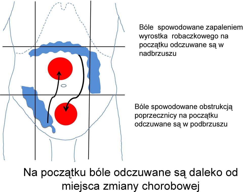 obstrukcją poprzecznicy na początku odczuwane są w