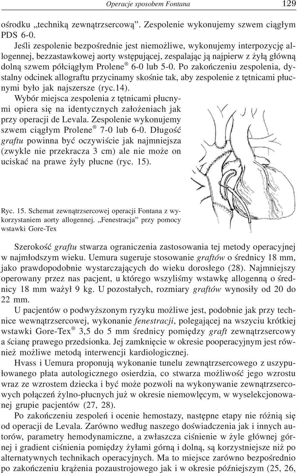 Po zakończeniu zespolenia, dy stalny odcinek allograftu przycinamy skośnie tak, aby zespolenie z tętnicami płuc nymi było jak najszersze (ryc.14).