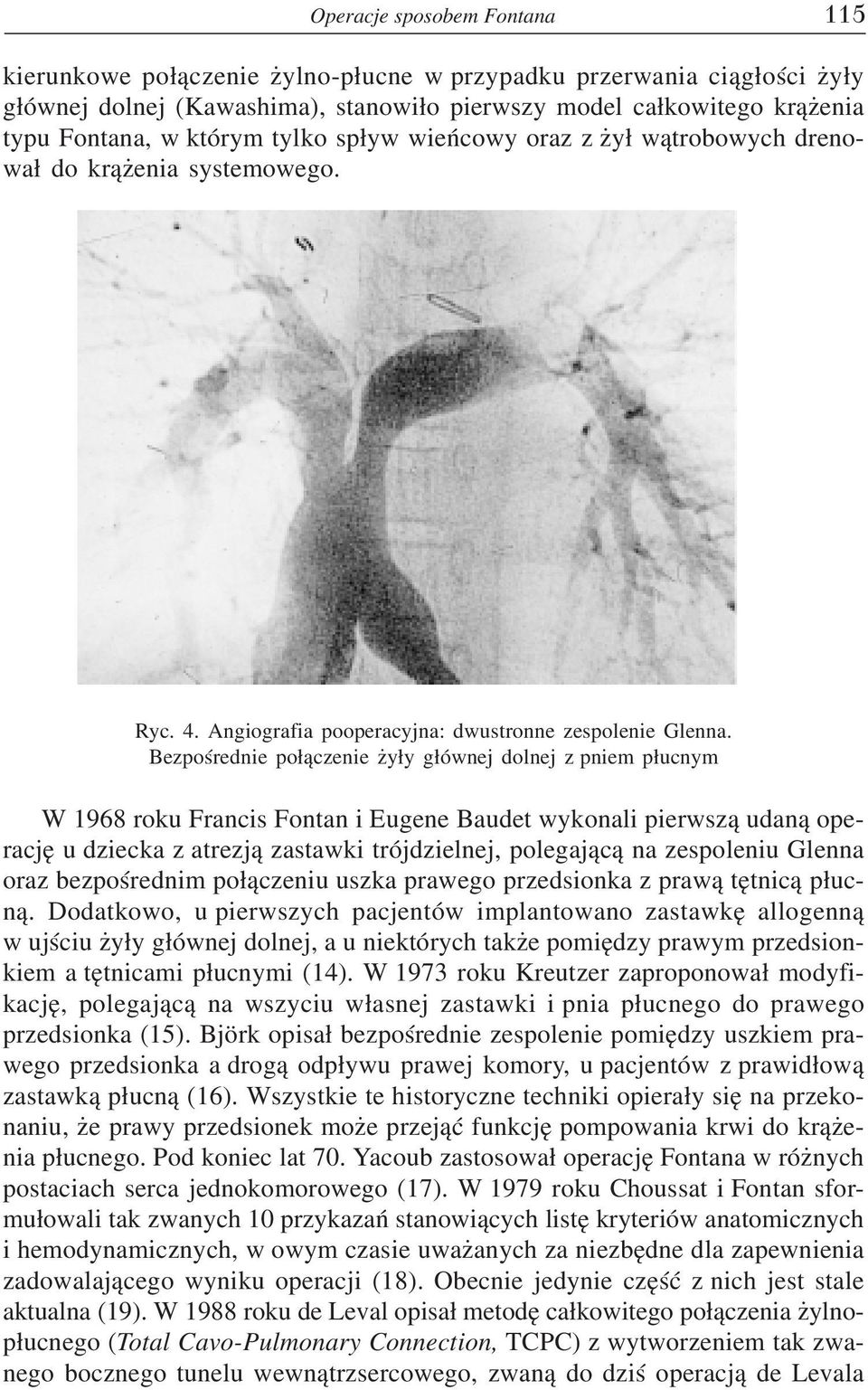 Bezpośrednie połączenie żyły głównej dolnej z pniem płucnym W 1968 roku Francis Fontan i Eugene Baudet wykonali pierwszą udaną ope rację u dziecka z atrezją zastawki trójdzielnej, polegającą na