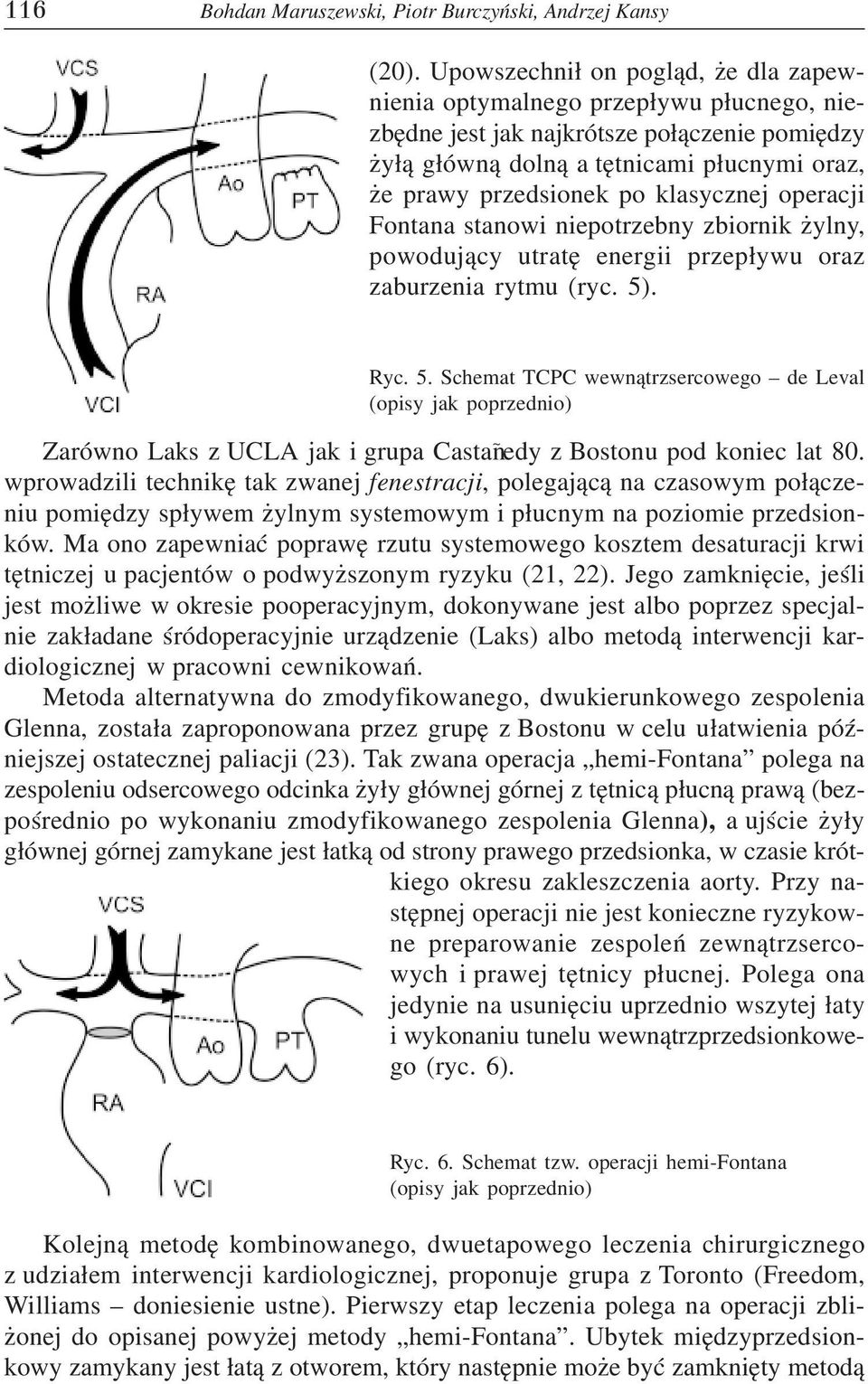 klasycznej operacji Fontana stanowi niepotrzebny zbiornik żylny, powodujący utratę energii przepływu oraz zaburzenia rytmu (ryc. 5)