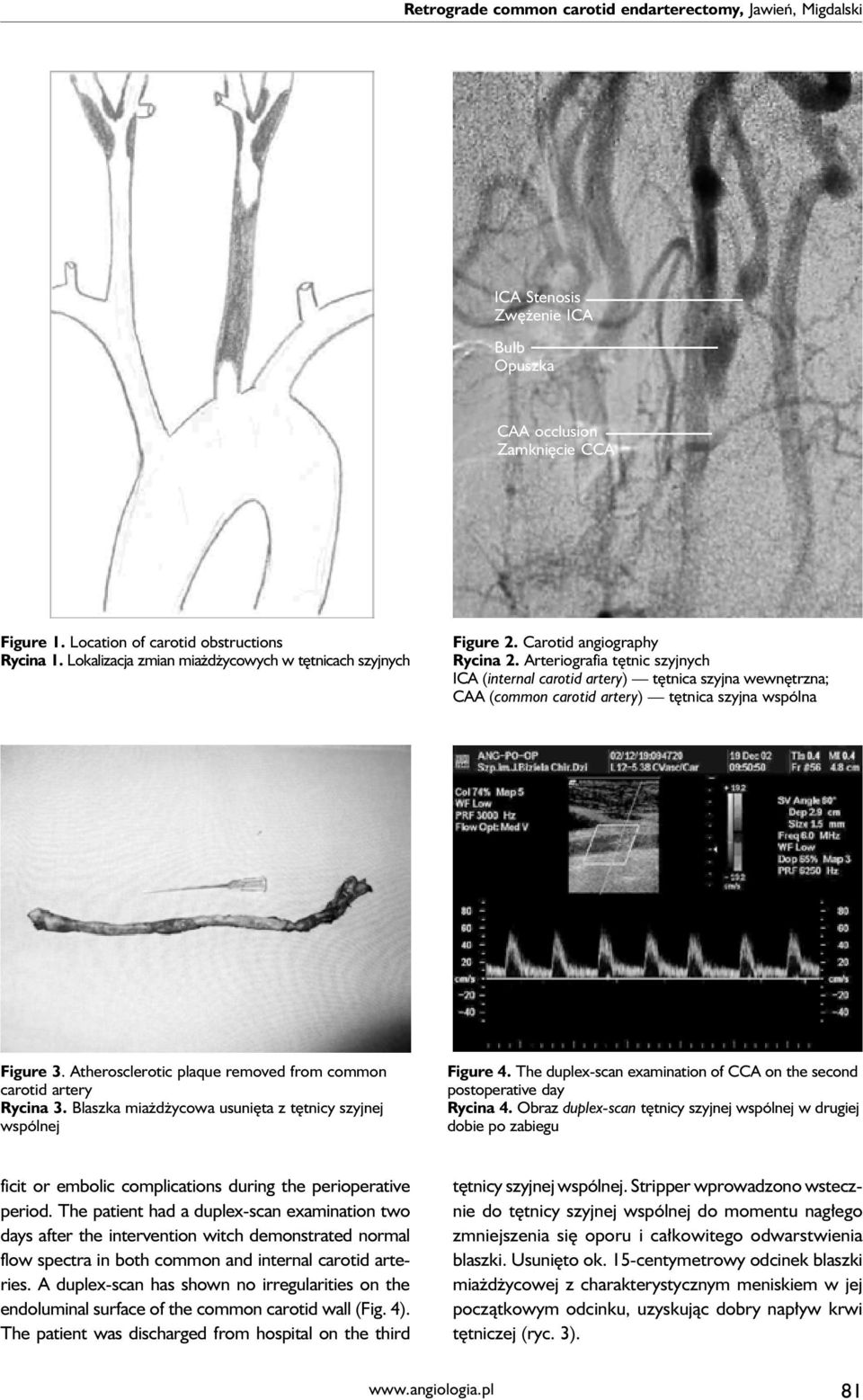 Arteriografia tętnic szyjnych ICA (internal carotid artery) tętnica szyjna wewnętrzna; CAA (common carotid artery) tętnica szyjna wspólna Figure 3.
