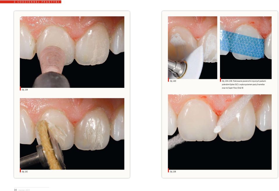 polerskimi Epitex (GC) z wykorzystaniem pasty