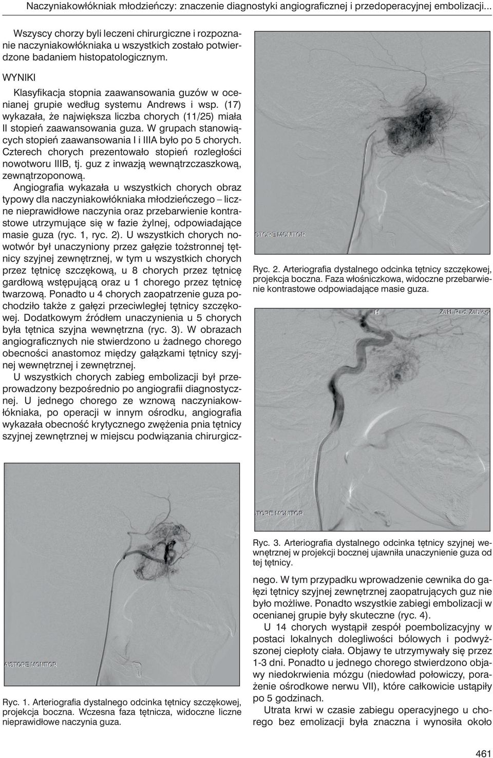 Arteriografia dystalnego odcinka tętnicy szczękowej, projekcja boczna. Faza włośniczkowa, widoczne przebarwienie kontrastowe odpowiadające masie guza. Ryc. 3.