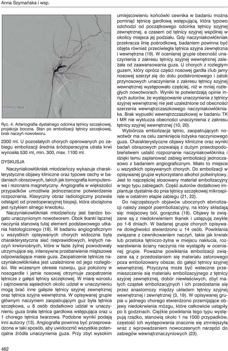 Dyskusja Naczyniakowłókniak młodzieńczy wykazuje charakterystyczne objawy kliniczne oraz typowe cechy w badaniach obrazowych, takich jak tomografia komputerowa i rezonans magnetyczny.