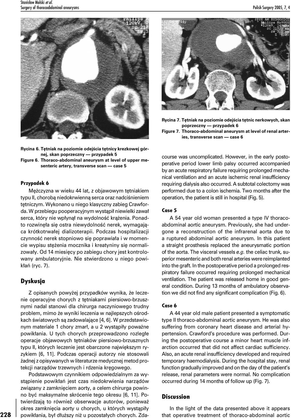 Thoraco-abdominal aneurysm at level of upper mesenteric artery, transverse scan case 5 Przypadek 6 Mężczyzna w wieku 44 lat, z objawowym tętniakiem typu II, chorobą niedokrwienną serca oraz