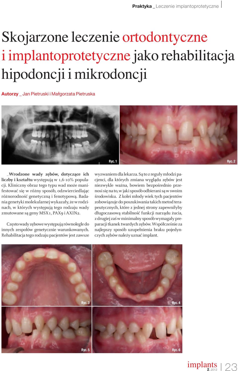 Kliniczny obraz tego typu wad może manifestować się w różny sposób, odzwierciedlając różnorodność genetyczną i fenotypową.